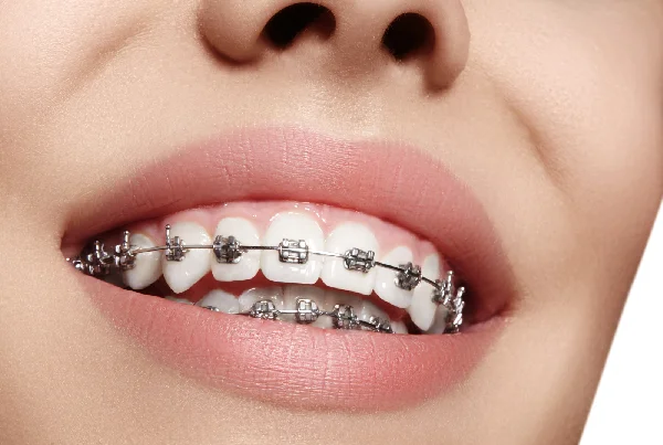 Orthodontic Treatment