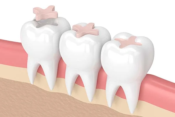 Tooth Coloured Feeling