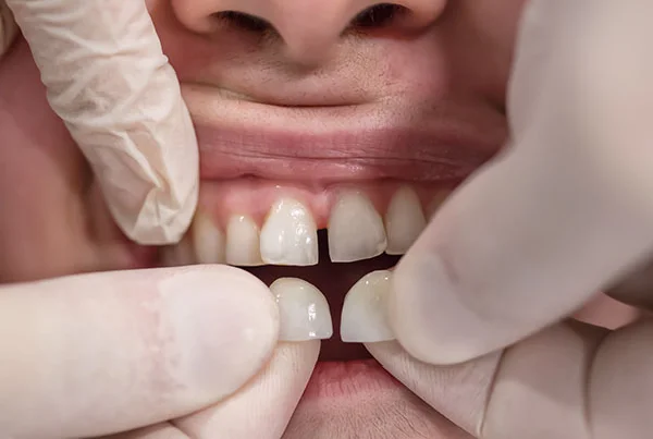 Veneers