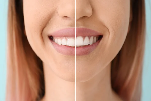 Gummy Smile Treatment