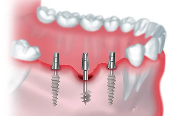 Basal Implant